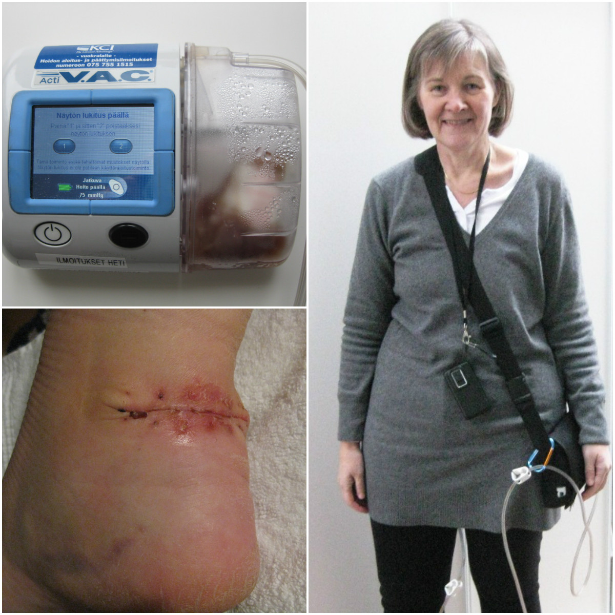 Alipainepumppu ja leikattu nilkka Alipainepumppu ja leikattu nilkka