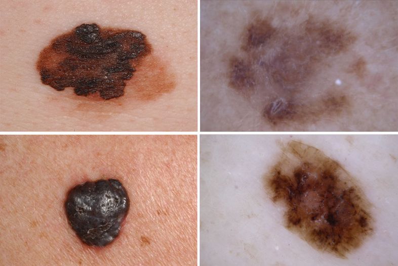 Melanoomaluomia Melanoomaluomia